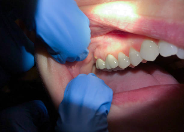 Best Emergency Dental Care for Broken or Chipped Teeth in Kinsey, AL